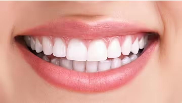 The same smile with noticeably whiter teeth after whitening