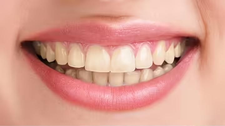 Discoloured teeth before professional whitening