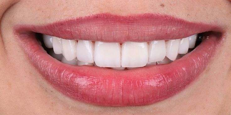 The same smile reshaped and evened out after cosmetic treatment