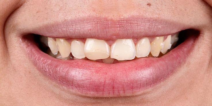 Worn and uneven front teeth before cosmetic treatment