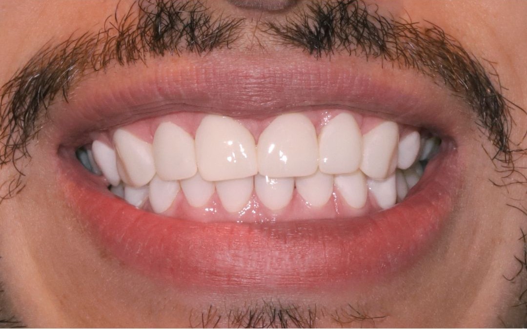 The same smile straightened and aligned after orthodontic treatment