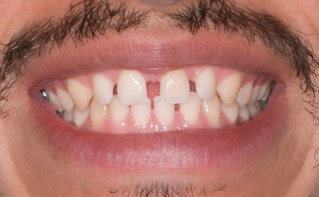 Crooked, gapped teeth before orthodontic treatment