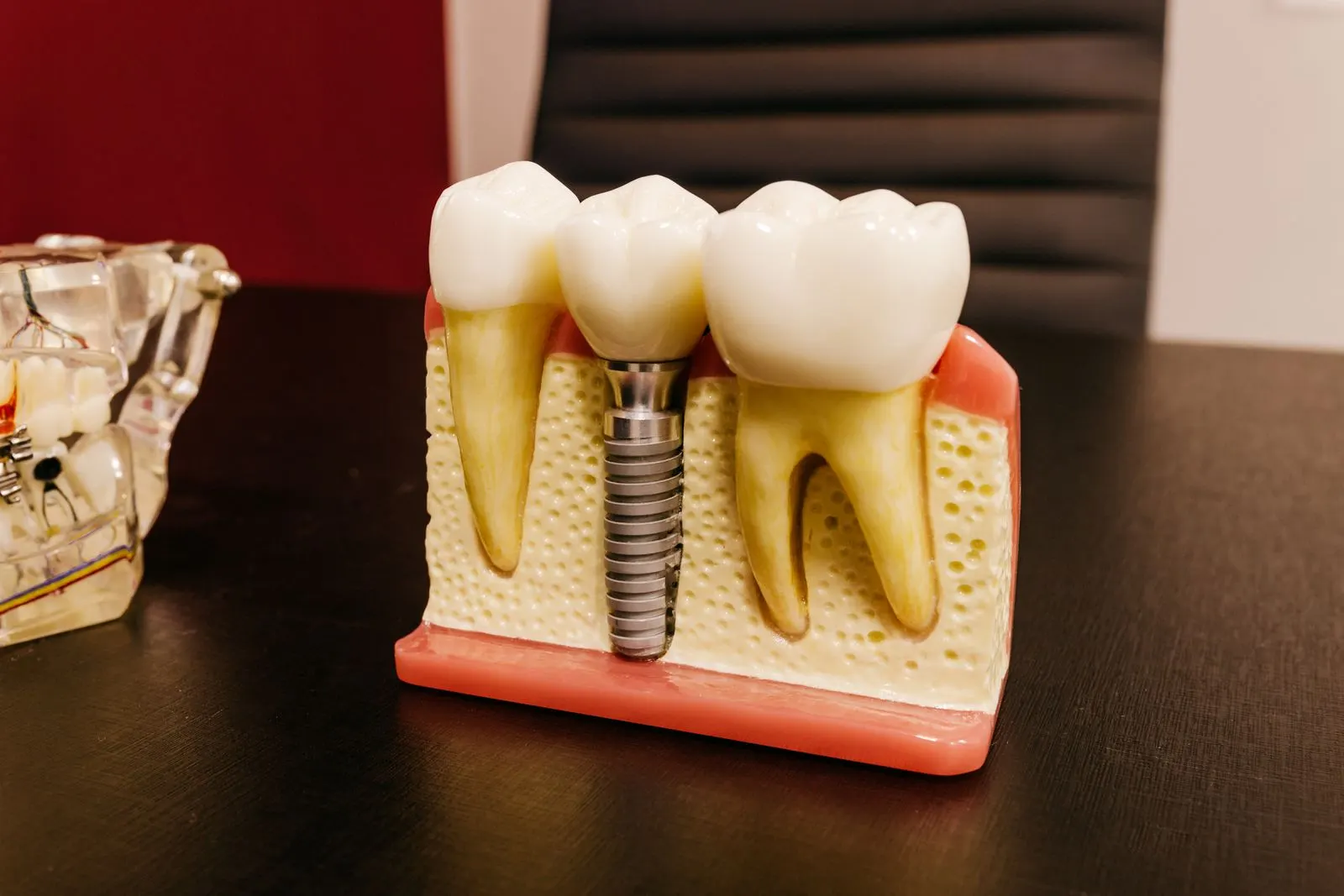 Dental Implants at Dr. Priya's Dentistry, Vettuvankeni, ECR Chennai